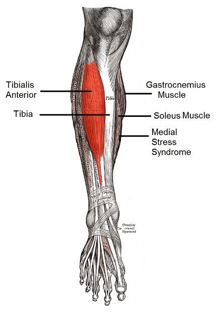 Medial tibial stress syndrome (shin splint) diagram showing the Tibialis Anterior, Tibia, Gastrocnemius Muscle and the Soleus Muscle.